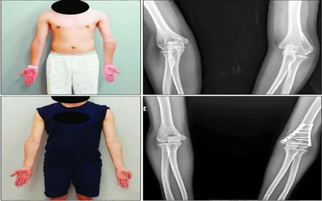 Functional Recovery