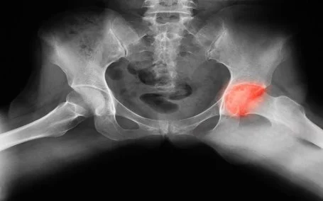 Derotational Osteotomy